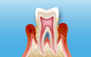 船橋市浜町・いいじま歯科・歯周病治療