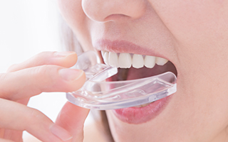 船橋市浜町・いいじま歯科・マウスピース作製